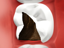 dental crown tooth colour