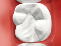 white dental cap match the color of teeth