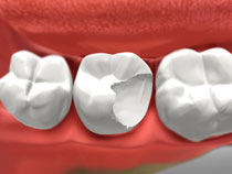 Dental Crowns in Whitby1