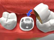 Dental Crowns in Whitby2