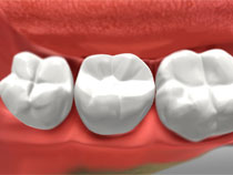 Dental Crowns in Whitby3