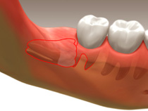 Tooth Extractions in Whitby1