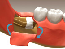 Tooth Extractions in Whitby2