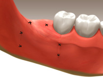 Tooth Extractions in Whitby3