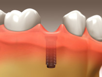 Dental Implants 2