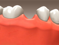 Dental Implants 1