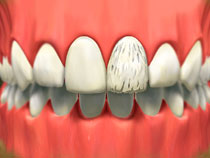 Porcelain Veneers Whitby1