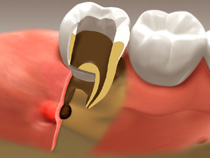 Root Canal Whitby2